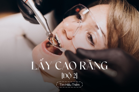 Lấy cao răng độ 2